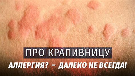 Вред от неправильного использования капы