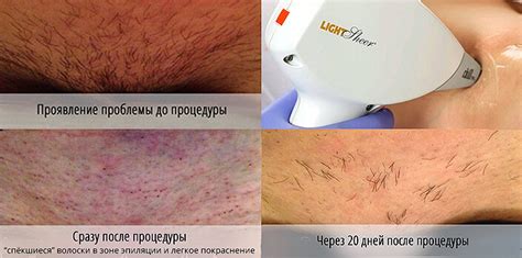 Временные ограничения после лазерной эпиляции