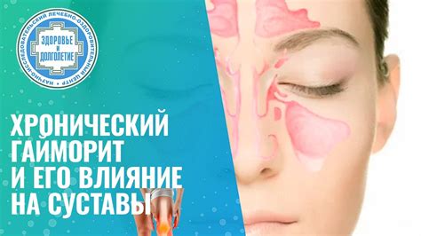 Гайморит и его влияние на заложенность носа
