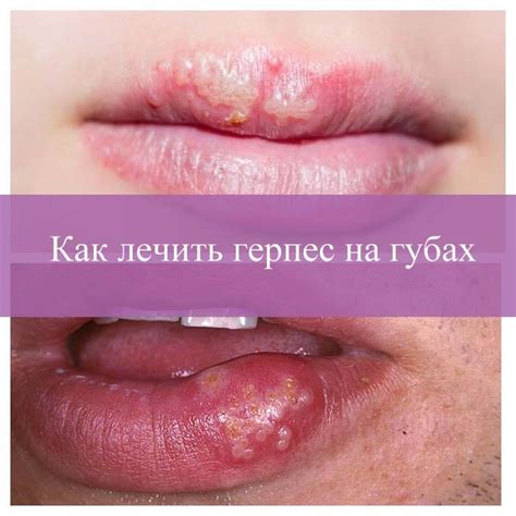 Герпес на губах: особенности вируса