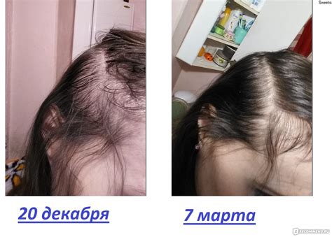 Дарсонваль: новое решение для уколов и шишек