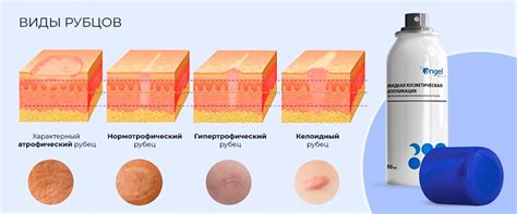 Дополнительные методы предотвращения шрамов
