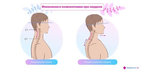 Информация о лордозе шейного отдела позвоночника