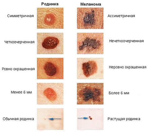 Какие родинки предпочитают парни