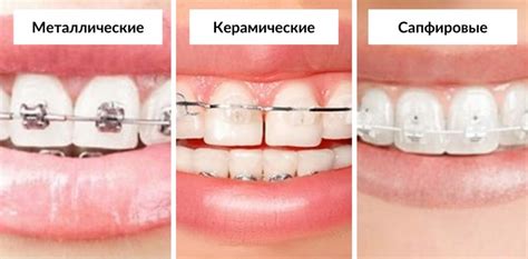 Как выбрать брекеты