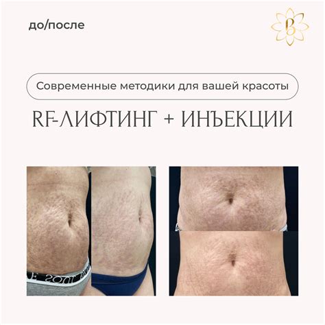 Как устранить растяжки на животе
