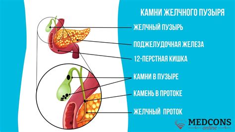 Кальций при желчекаменной болезни: как обезопасить его прием