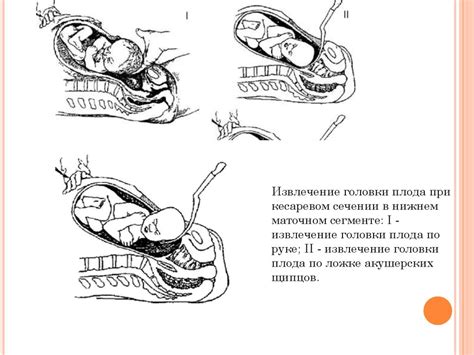 Кесарево сечение при ОРВИ