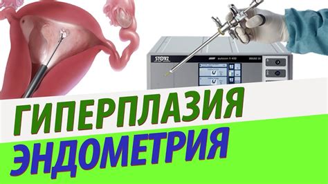 Комплекс упражнений, помогающий справиться с симптомами гиперплазии эндометрия