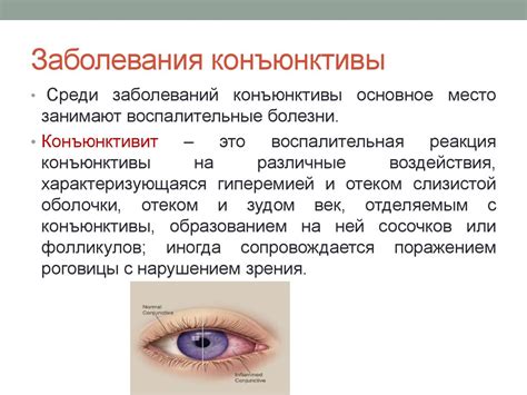 Конъюнктивит - воспаление глазной слизистой оболочки