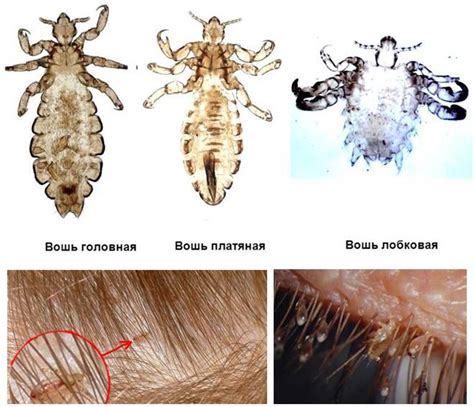 Лечение вшей и контроль передачи от человека к человеку