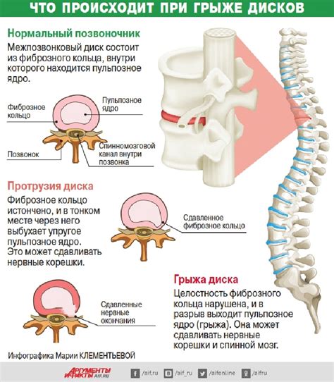 Лечение грыжи и поноса: основные подходы