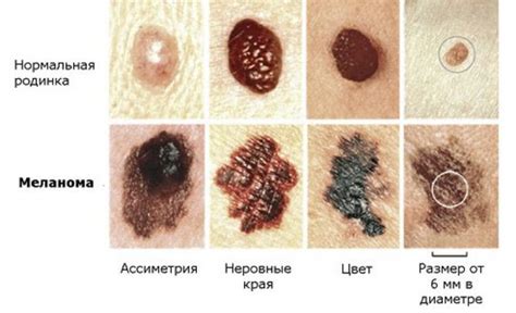 Лечение метастазов в начальной стадии рака
