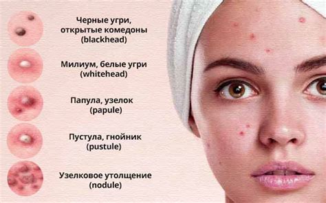 Локализация прыщей и их связь с проблемами органов