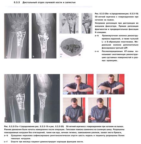 Ломкость костей и повышенный риск возникновения переломов