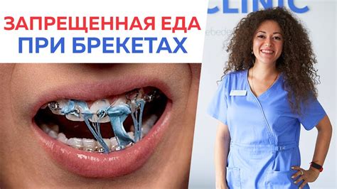 Лучшие продукты для ускорения процесса РФ лифтинга при ношении брекетов