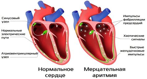 Мерцательная аритмия: симптомы и диагностика