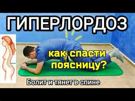 Методы исправления лордоза