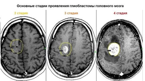 Методы лечения группы при опухоли головного мозга