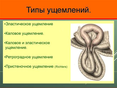 Механизм возникновения поноса при грыже