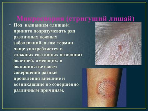 Микроспория гладкой кожи: правила и рекомендации для купания