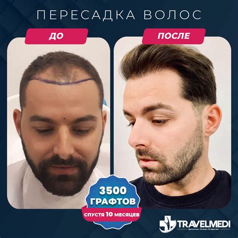 Минусы пересадки волос в Турции