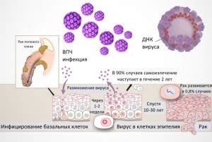 Миф о заражении ВПЧ после одного полового акта