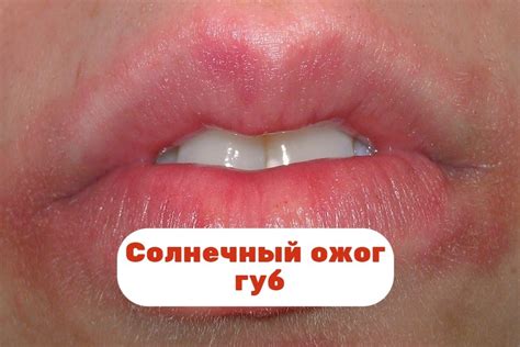 Негативное влияние на кожу губ