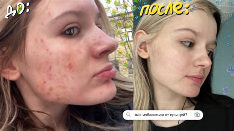 Ограничения и противопоказания при прижигании прыщей на лице чистотелом