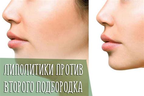 Операционные методы и их эффективность при удалении второго подбородка