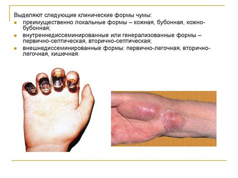 Основные симптомы чумы