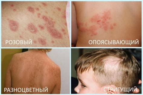 Первые признаки лишая и его лечение