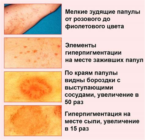 Плоский лишай