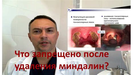 Плюсы и минусы удаления миндалин при повышенном АСЛО