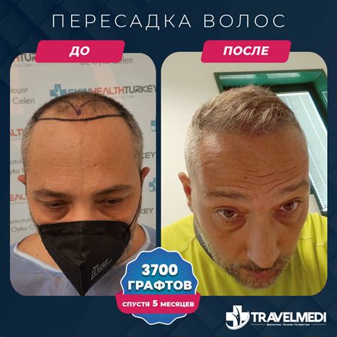 Плюсы процедуры пересадки волос в Турции