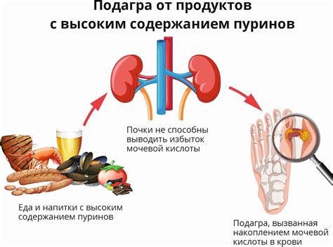 Подагра: причины и симптомы