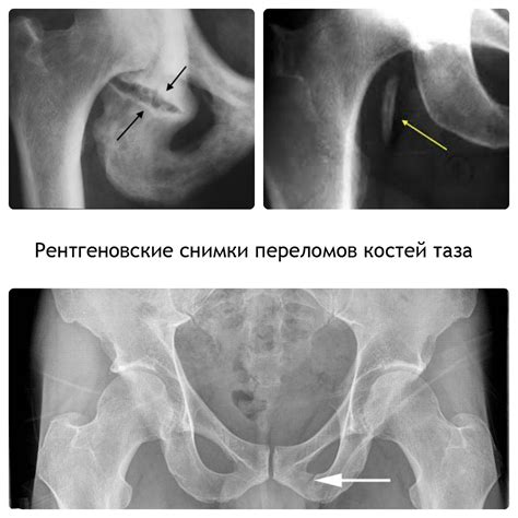 Последствия рождения после перелома таза