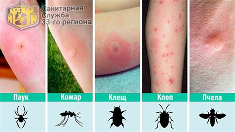 Почему укусы клопов вызывают зуд