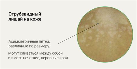 Предотвращение загара при наличии лишая