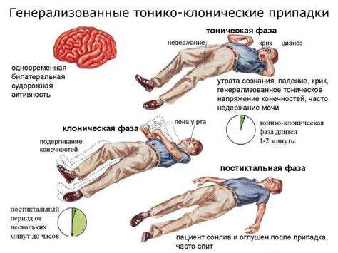 Предпосылки возникновения приступа эпилепсии