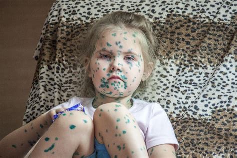 Преимущества заражения ветрянкой