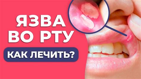 Преимущества использования левомекола при лечении язв во рту