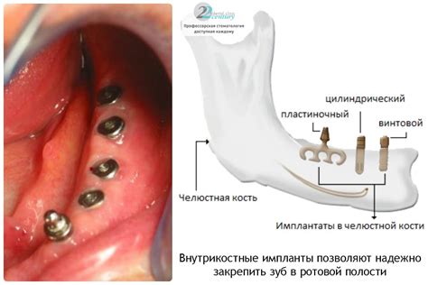Преимущества и недостатки металлических имплантатов