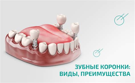 Преимущества ставления коронки