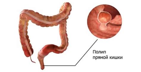 Признаки полипа в прямой кишке