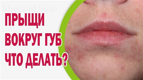 Приращение губы от прыща - что не делать