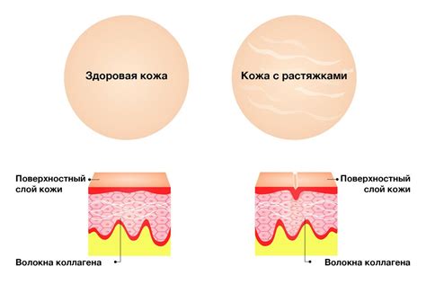 Причины возникновения растяжек на животе