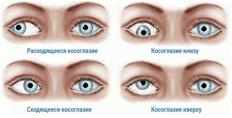 Причины двоения в глазах