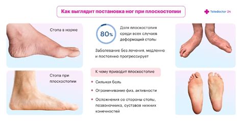 Причины отека ног при плоскостопии