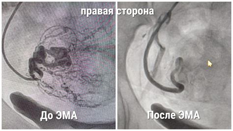 Причины плохой цитологии при миоме